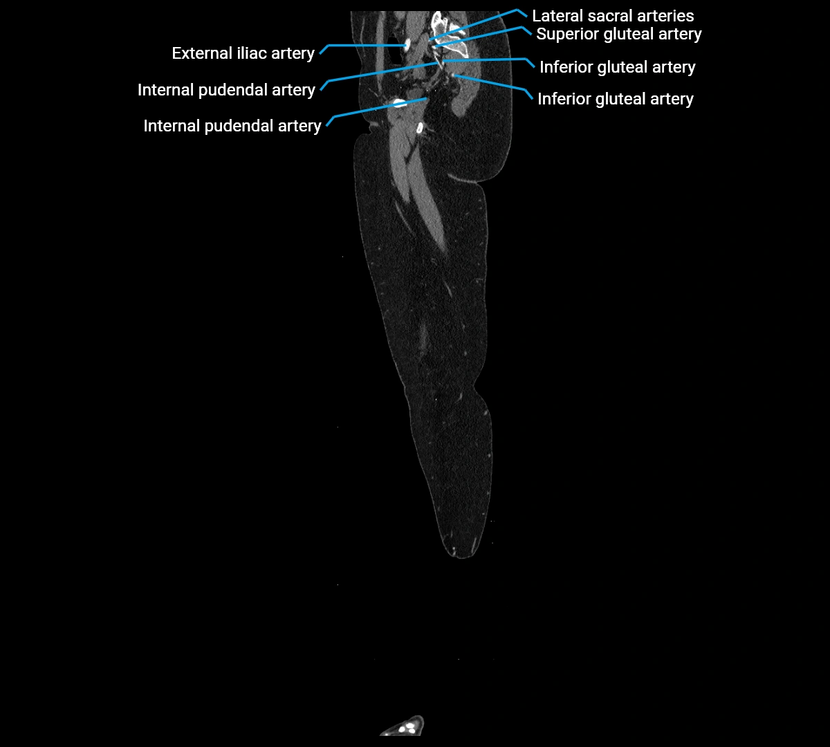 CTA lower limb sagittal cross sectional anatomy labelled image _14 (3).webp
